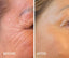 Botox by advanced and experienced aesthetics practitioner Kate at Beauty At Gosforth Park Newcastle