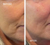 natural cheek filler Gosforth Newcastle upon tyne