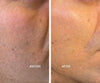 natural cheek filler Gosforth Newcastle upon tyne
