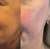 natural cheek filler Gosforth Newcastle upon tyne