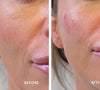 natural cheek filler Gosforth Newcastle upon tyne