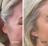 Botox x3 Areas