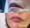 Lip Fillers 0.5ml