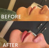 Lip Fillers 1ml