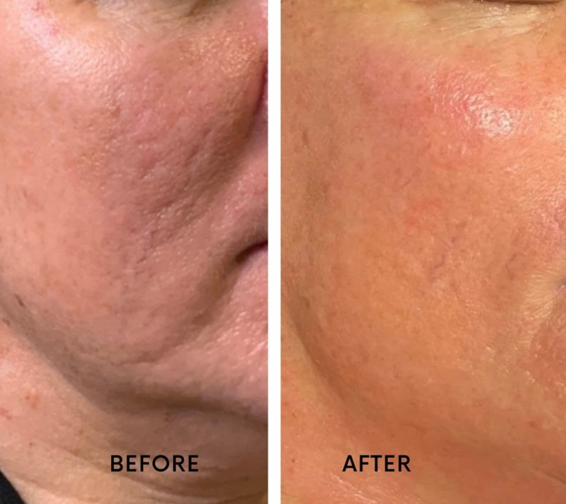 Microneedling Treatment | Beauty At Gosforth Park | Newcastle Upon Tyne