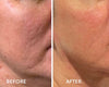 Microneedling | Beauty At Gosforth Park | Newcastle Upon Tyne